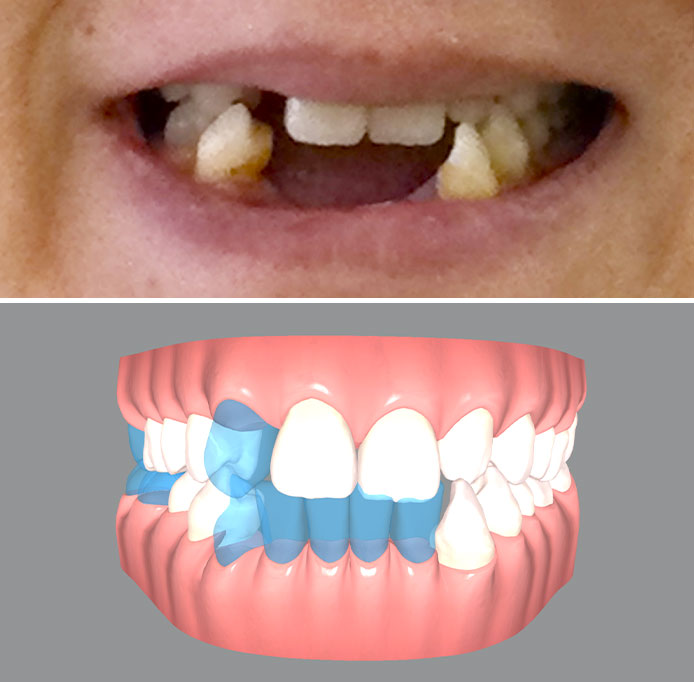 POINT2矯正歯科治療・かみ合わせ治療で審美的で機能的な歯並びへ