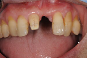 上顎中切歯のGBR併用インプラント同時埋入