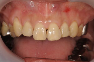 上顎６前歯のポーセレンラミネートベニア