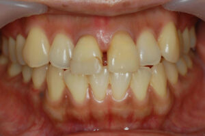 上顎中切歯の隙間改善とホワイトニンング