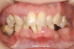 顎機能障害と歯周病による欠損に対してインプラントの治療