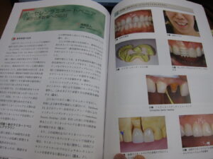 デンタルダイヤモンドにポーセレンラミネートベニアの論文掲載！