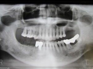 歯周病で歯が抜けた場合のインプラント