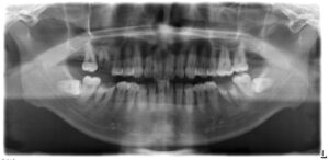 第１大臼歯３本をインプラント治療、２３歳男性！