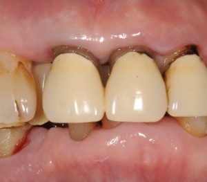 失活歯（歯頚部）変色