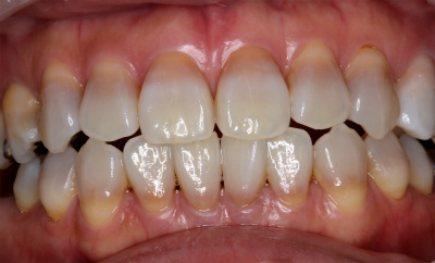歯が黄色くなる8つの原因と治療法 - 池田歯科大濠クリニック