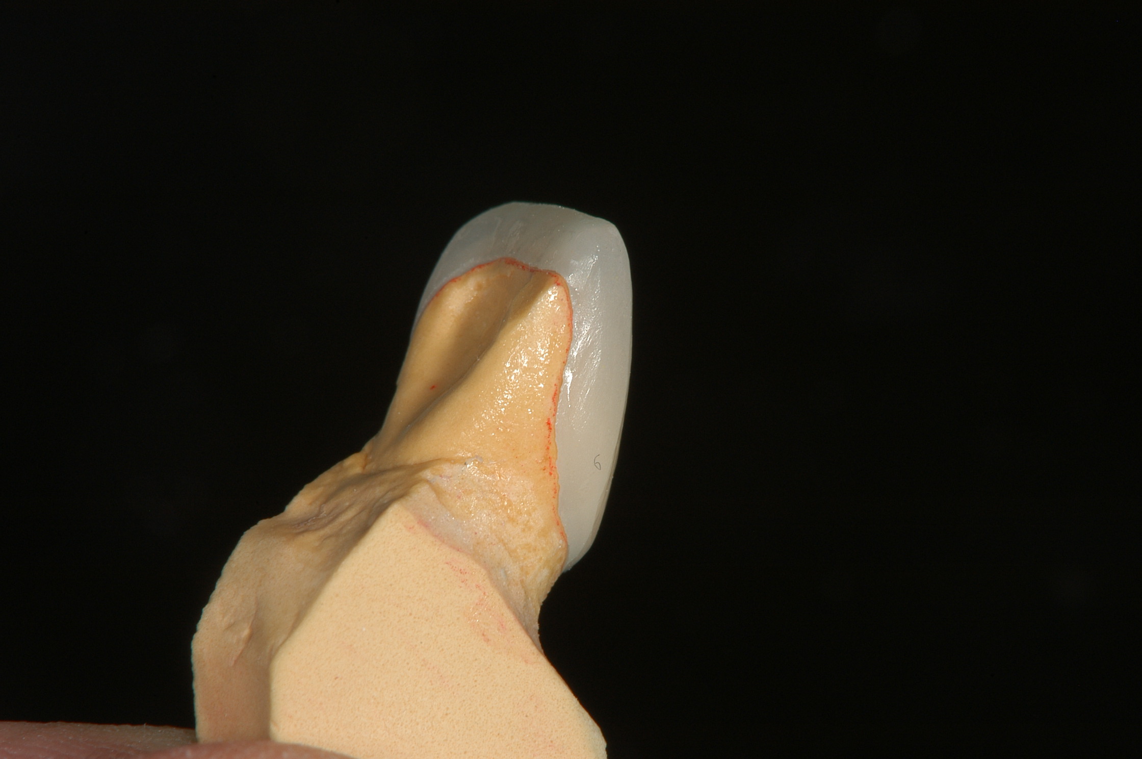 ラミネートベニアで綺麗な笑顔を手に入れませんか？ - 池田歯科大濠