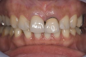 上顎中切歯のインプラント治療について